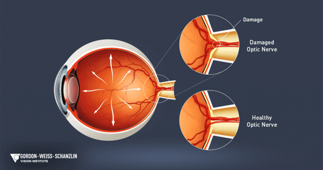 GWSVI Glaucoma Awareness Month - Eyeball graphic