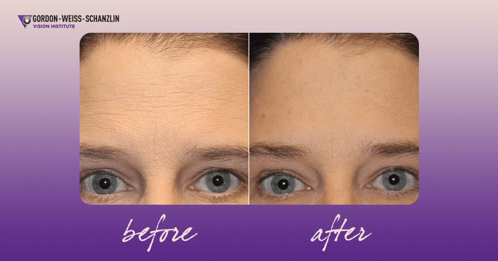GWSVI_botox_before_after