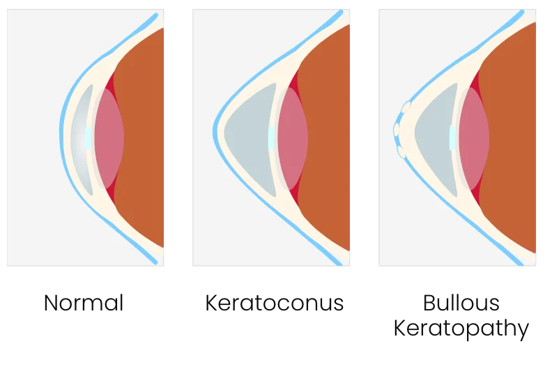 Eye graphic for Keratoconus