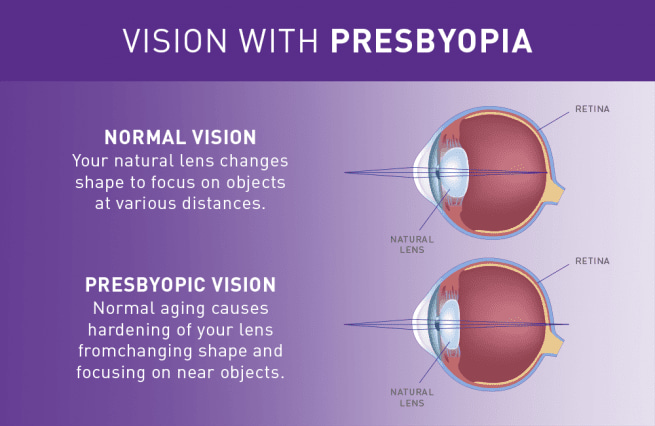 vision with presbyopia graphic