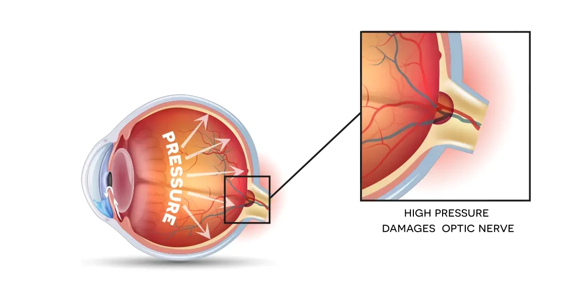 glaucoma diagram