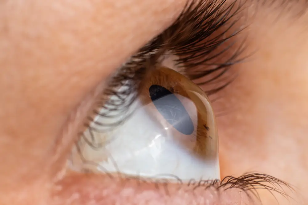 close up of an eye ball with keratoconus